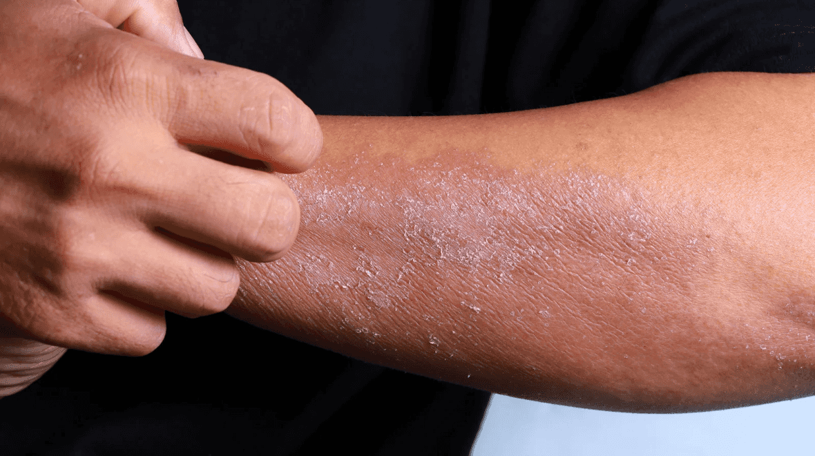 Everything we know about new eczema treatment developed at Trinity College Everything we know about new eczema treatment developed at Trinity College